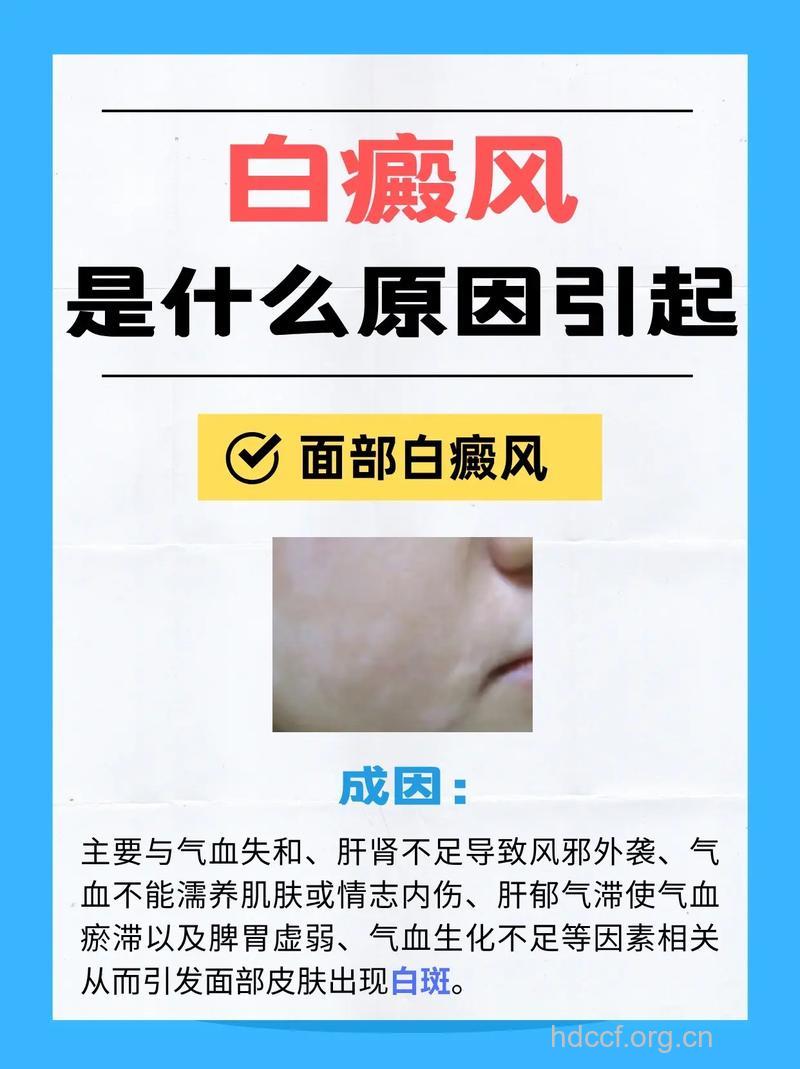 白癜风也会导致女性月经不调