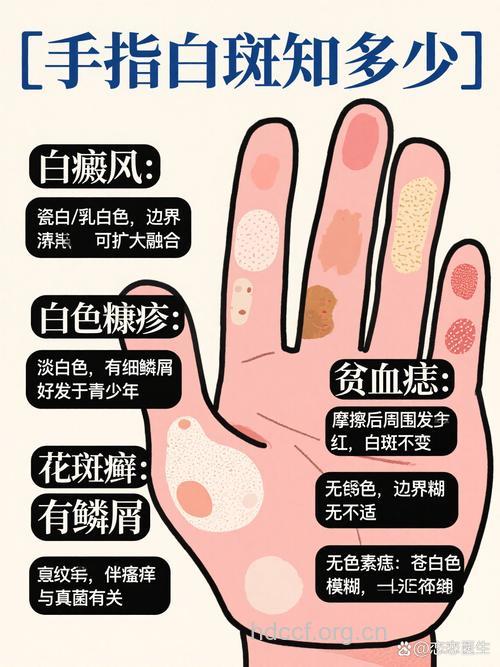 手部白癜风的发病原因