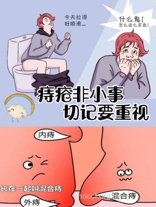 你还在为痔疮困扰吗?