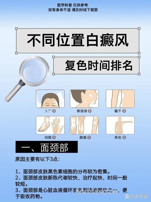 白癜风为何容易复发