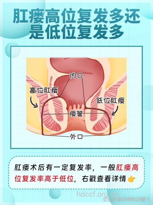 分析：肛瘘术后复发的原因