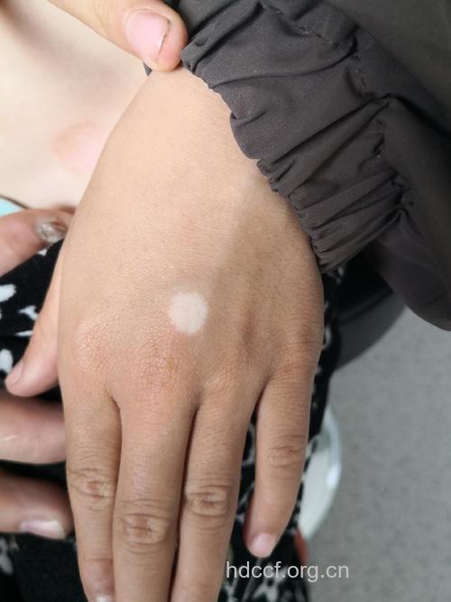 散发性白癜风的症状表现