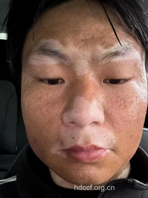 白领可能是白癜风潜在患者