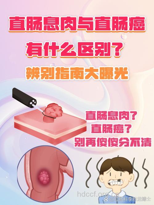 直肠癌和直肠息肉的区别 4个症状教你区分