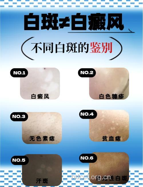 勿把白癜风当成脱色素性痣