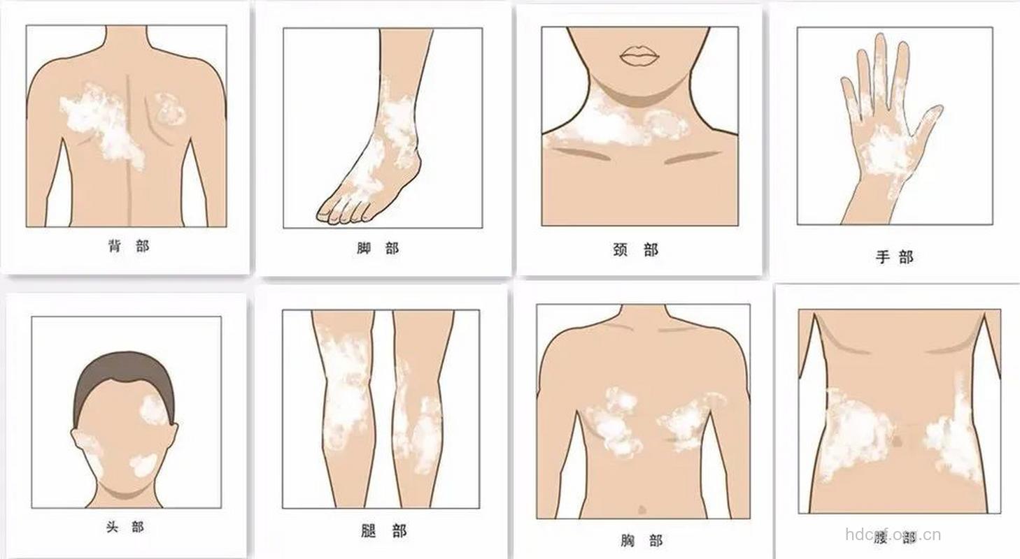 白癜风多发部位盘点