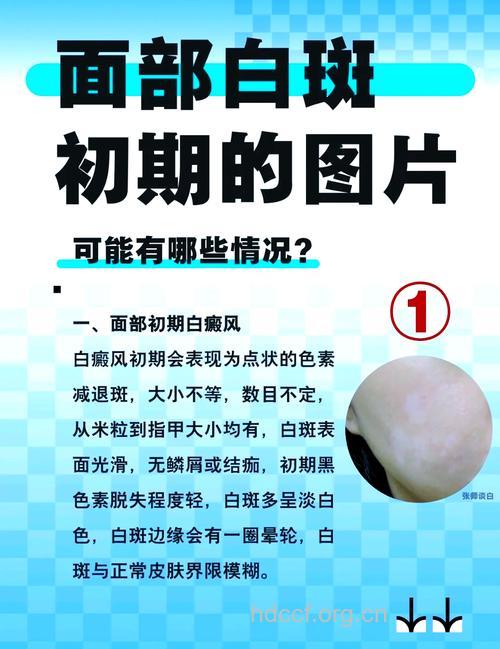 不同阶段白癜风的特征表现