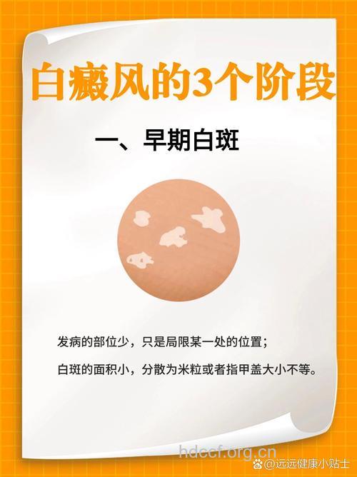 白癜风发展包括3个阶段