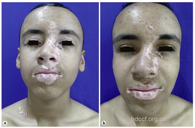 白癜风引起的并发症有哪些