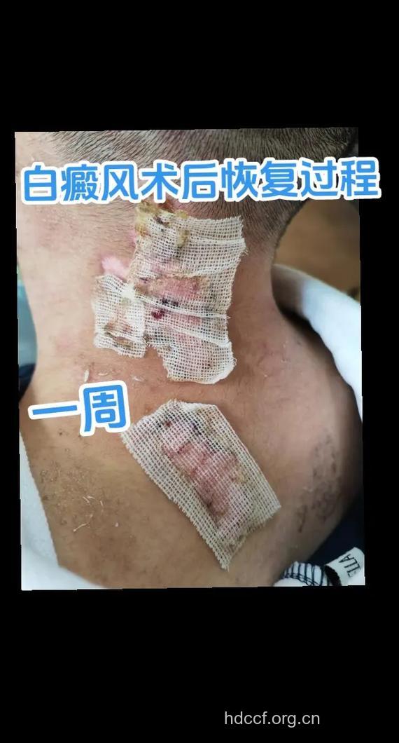 黑素细胞移植治疗白癜风