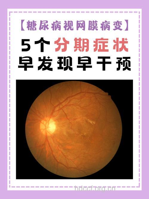 糖尿病黄斑变性是怎么回事？