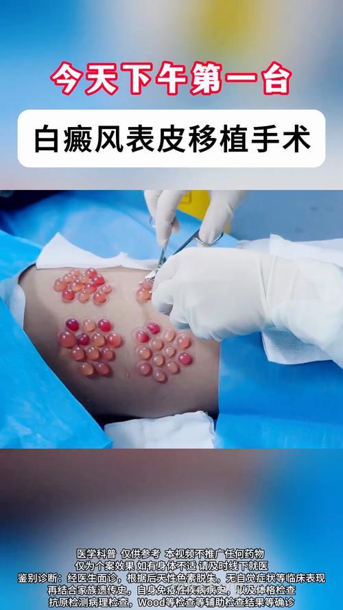 激光为辅的自体表皮移植术治疗白癜风