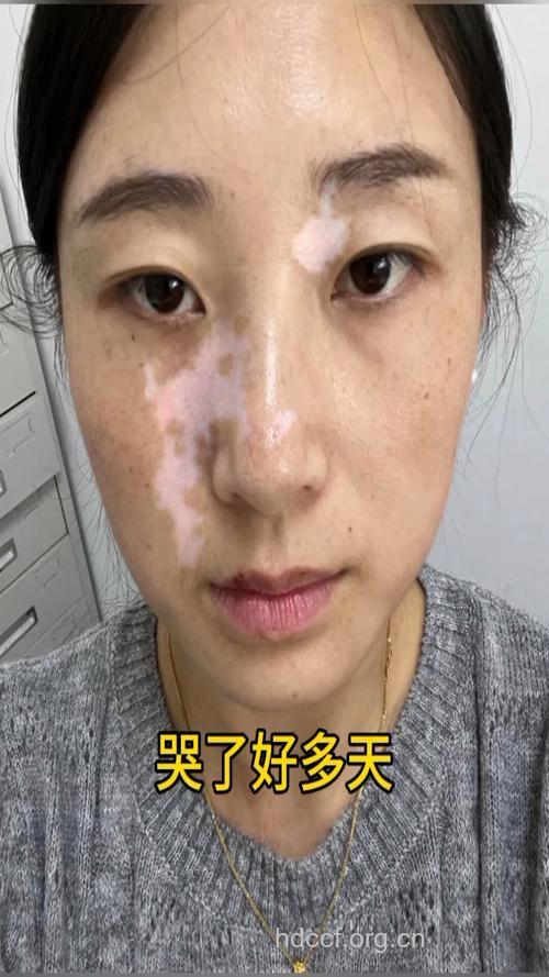 女性面部白癜风的症状有哪些