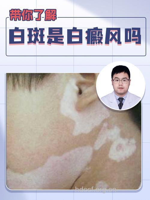 皮肤变白就是白癜风吗