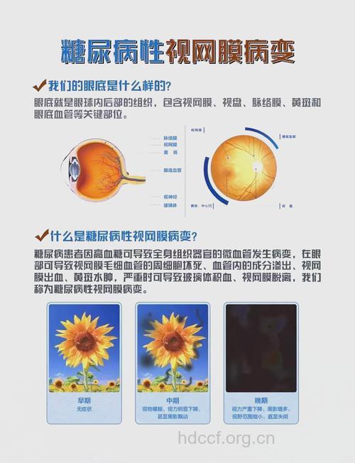 糖尿病视网膜病变 应早防早治