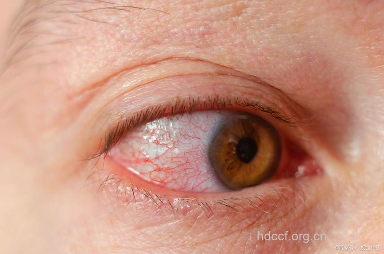 糖尿病眼病常见症状