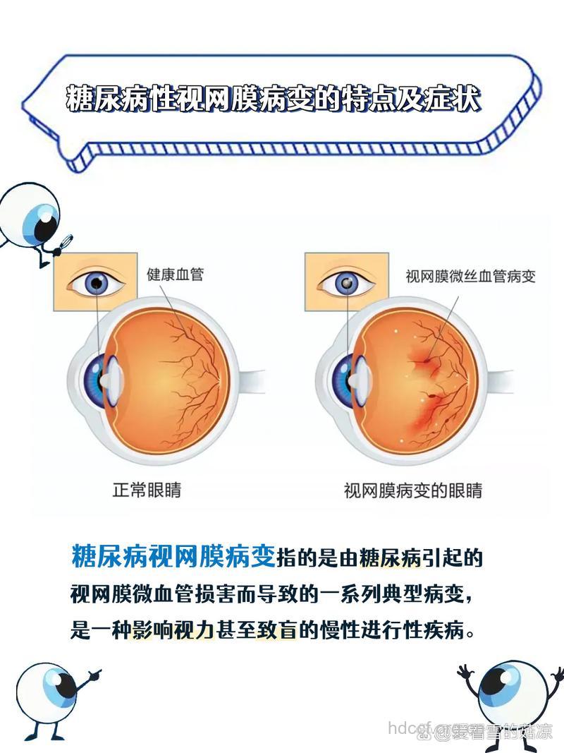 警惕几种糖尿病性的视网膜症状