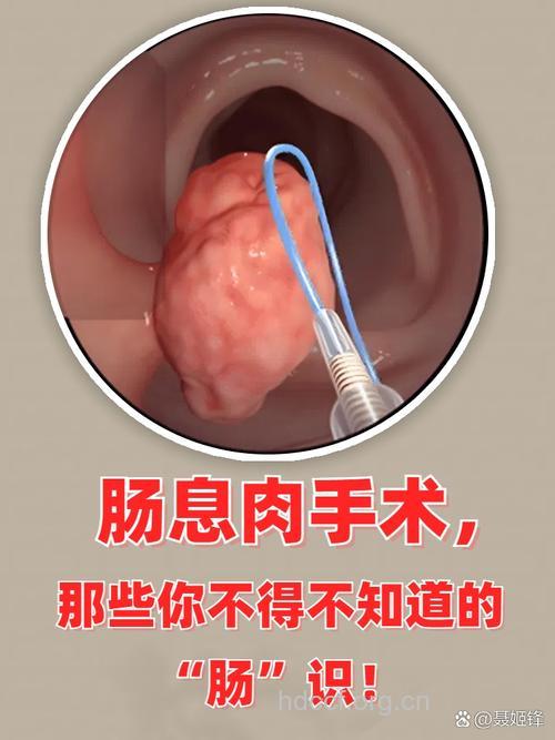 直肠息肉只能手术吗
