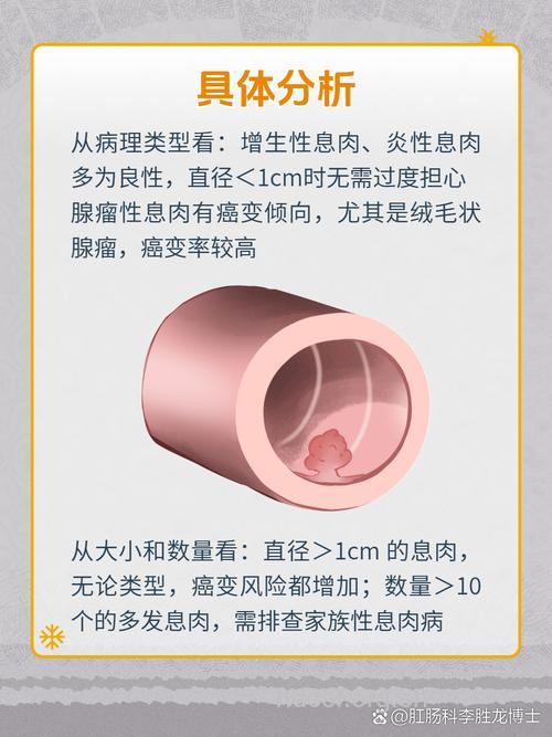 直肠息肉有哪些常见类型