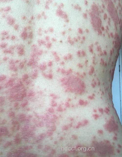 什么是牛皮癣的血热症状