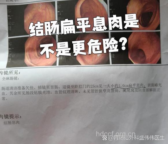 直肠息肉属良性病变吗