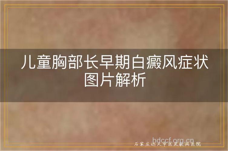 乳房上会长白癜风吗