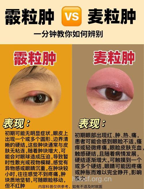 针眼的基础知识有哪些