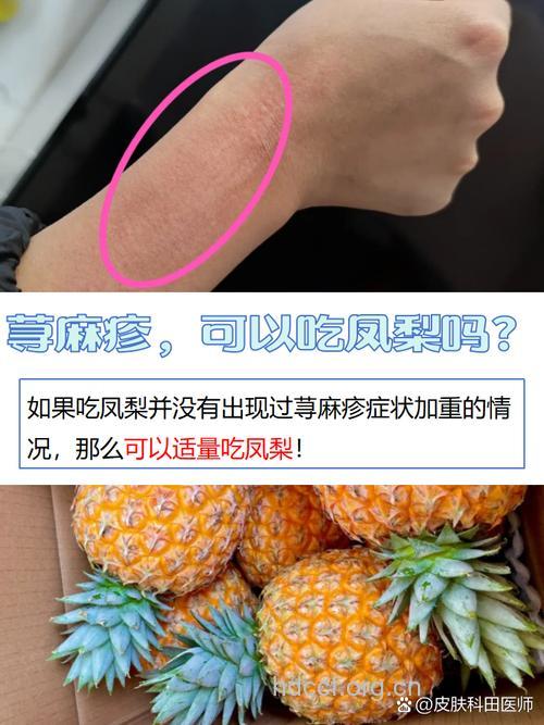 吃菠萝容易过敏吗?