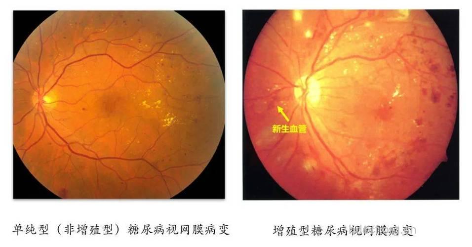 糖尿病性视网膜病变致盲