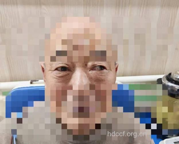 哪些疾病会引起糖尿病一样的眼帘下垂？