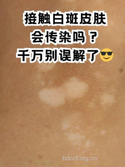 临床白癜风会通过性传播吗