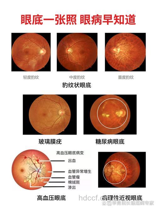 糖尿病眼病分为几种类型