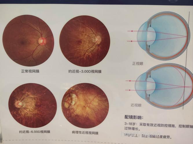 糖尿病眼病视网膜检查很必要