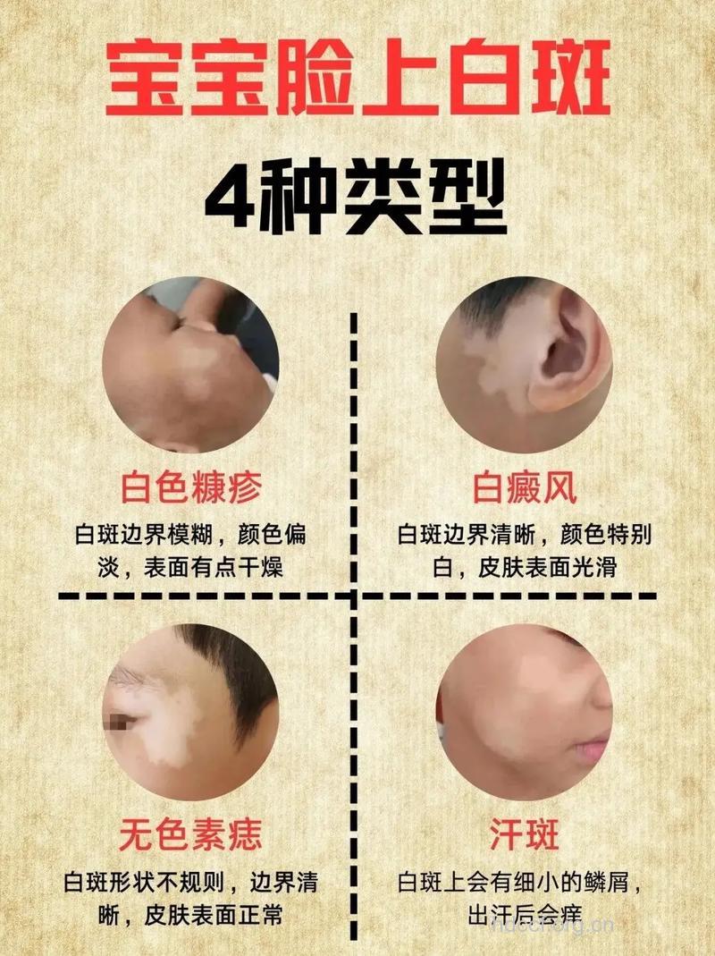 婴儿白癜风的症状有哪些