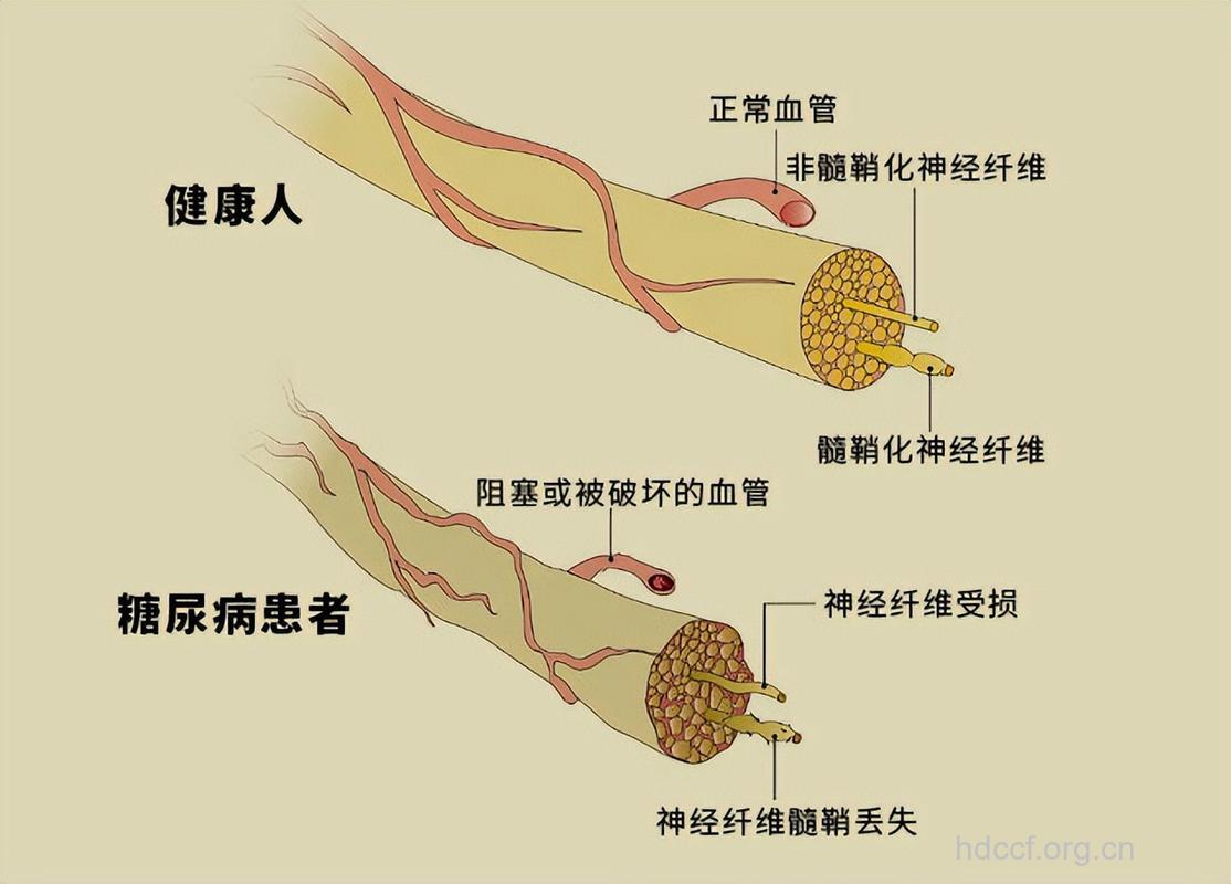 糖尿病与脑血管病的联手