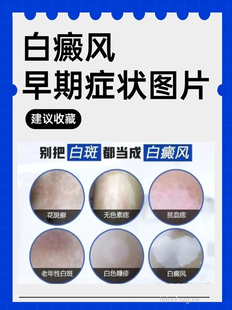 白癜风有什么发病先兆