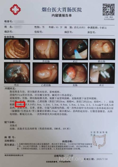 直肠息肉怎么确诊呢