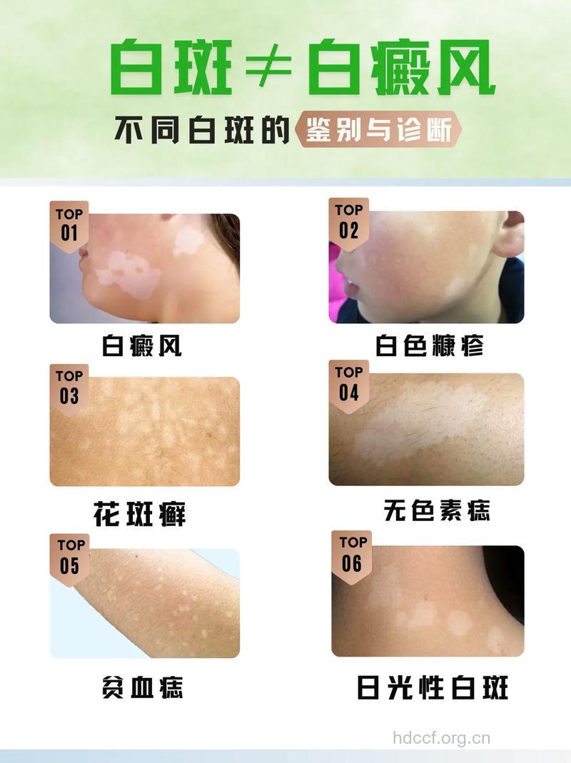白癜风是什么病