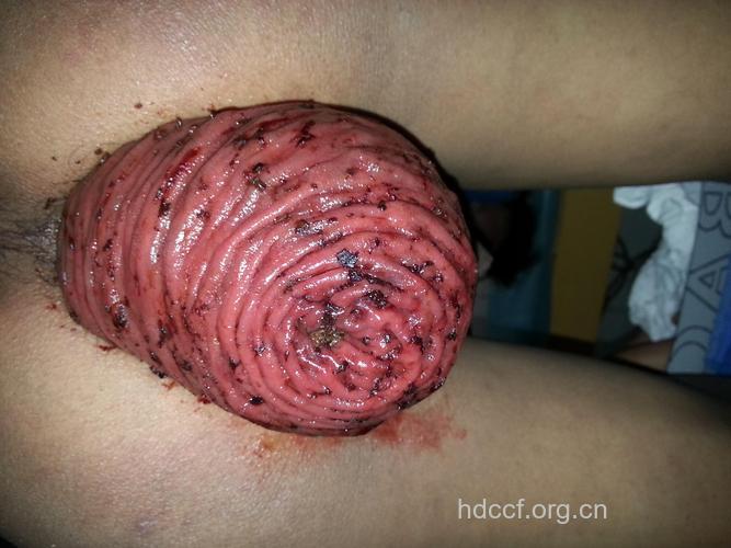 直肠脱垂的症状