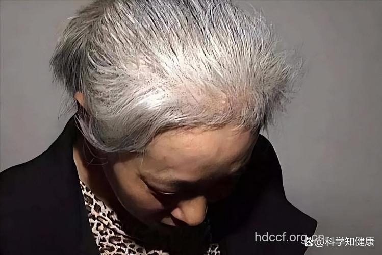 老人长期染发易诱发癌症