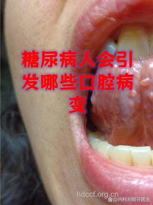 糖尿病患者易得的五种口腔疾病