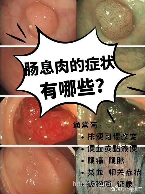 直肠息肉有什么临床表现