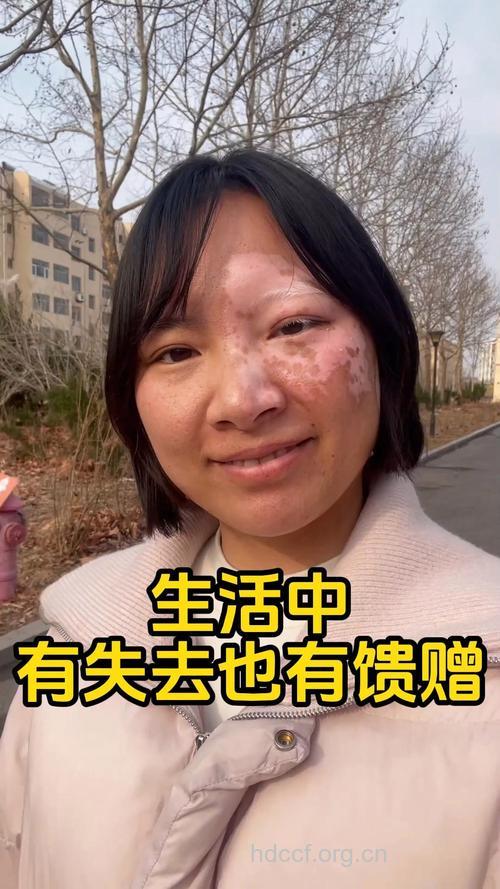 白癜风偏偏青睐高学历的女性!