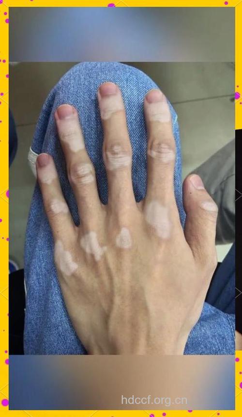 白癜风长在手上让我成了宅男