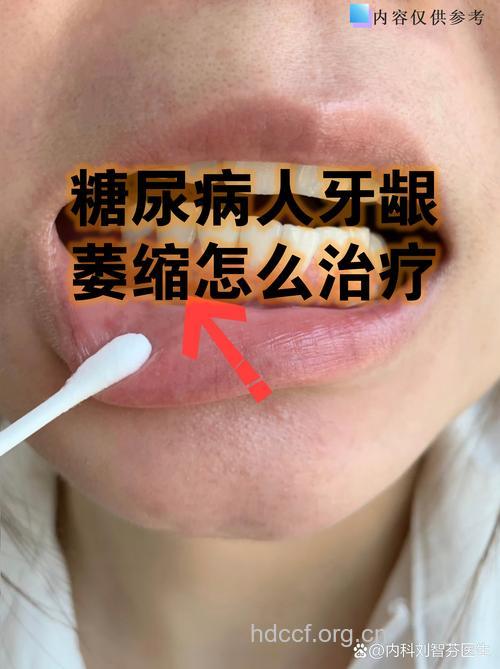 糖尿病牙周病能治好吗