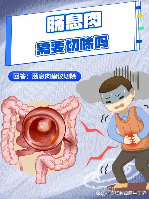 直肠息肉需要治疗吗?