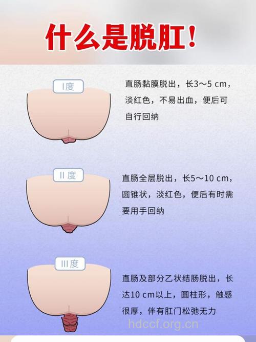 脱肛的定义及症状分类