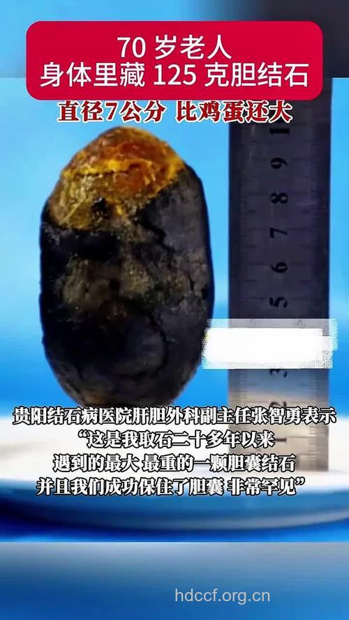 糖尿病“连理”胆结石?