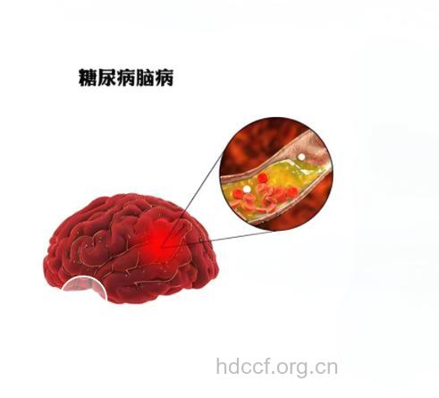 糖尿病性脑病的治疗