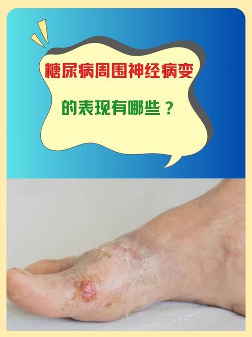 糖尿病患者发生神经病变有哪些自觉症状?